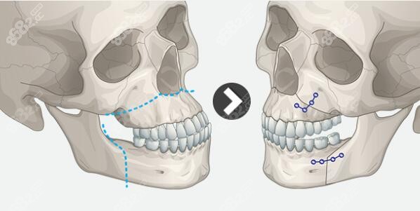 广州正颌手术的价格