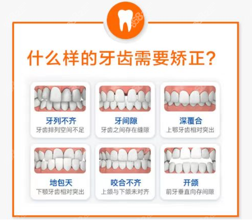 南宁柏乐口腔医院常做的牙齿矫正类型