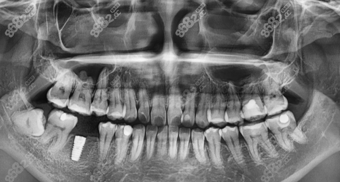烟台壹颗牙口腔种植牙示意图