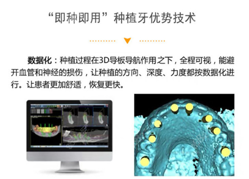 南京卡瓦口腔医院即刻种植牙技术