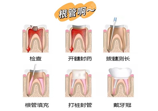 鹤壁口腔医院根管治疗