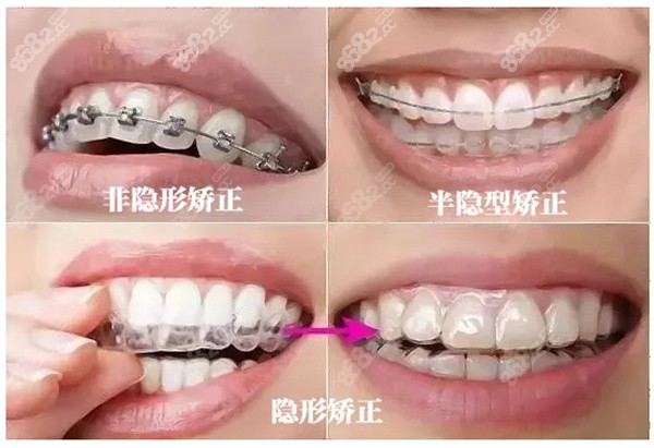 金属矫正器、半隐形矫正器、隐形牙套的区别