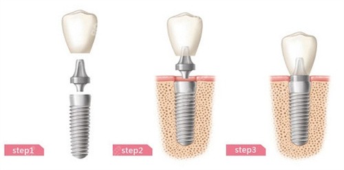 种植牙分解示意图