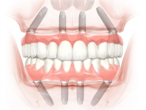 全口种植牙示意图
