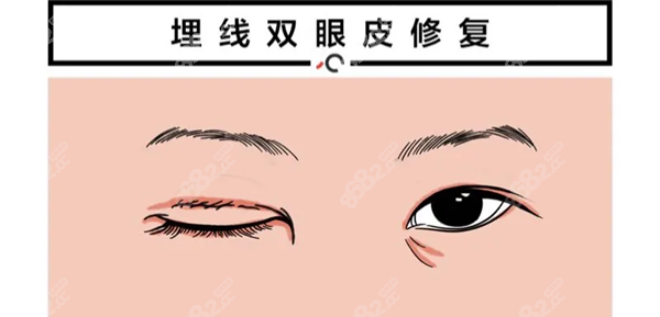 李艳霞做埋线双眼皮修复手术