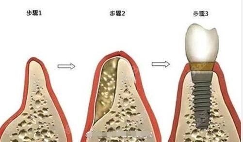 种植牙的步骤 种植牙的步骤