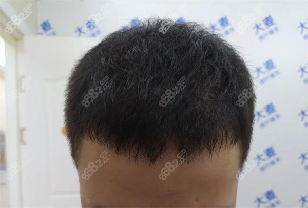 成都植发费用一般多少钱？