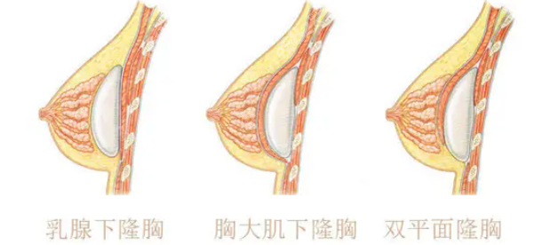 假体隆胸放置位置