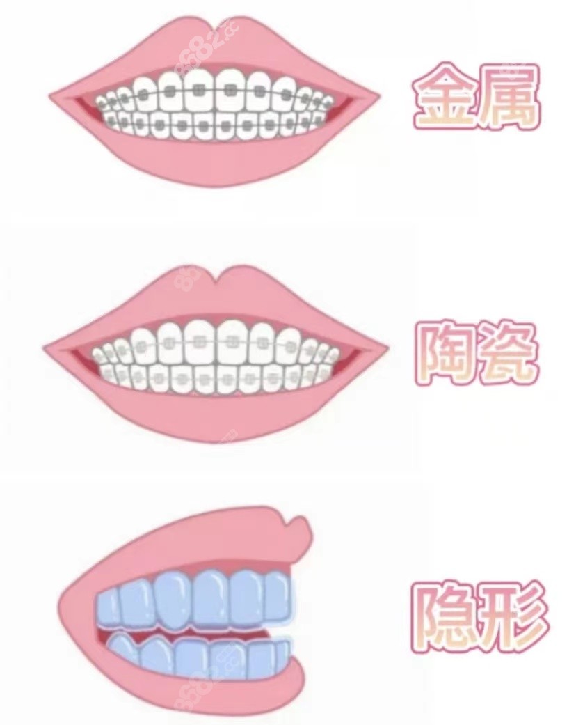 牙齿矫正型号有：金属牙套、隐形牙套