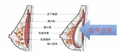 刘歆医生在隆胸方面的技术优势1