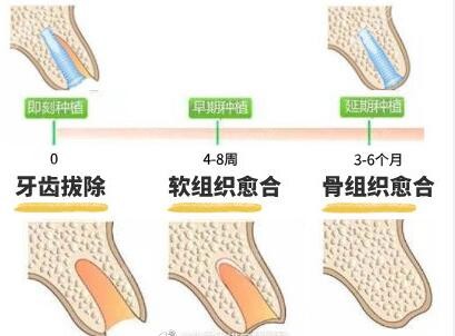 种植牙等待愈合期 种植牙等待愈合期