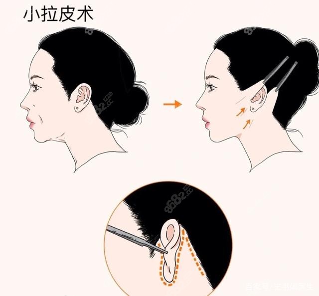 www.8682.cc提供的武汉五洲美莱整形拉皮手术过程