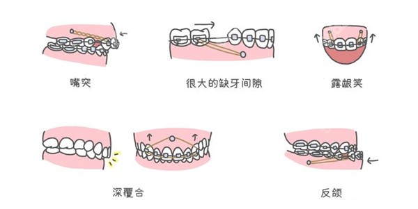 太原龅牙牙齿矫正多少钱