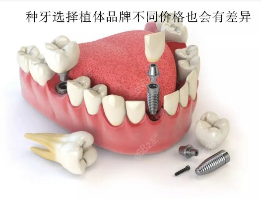 单颗种植牙价格表8682.cc