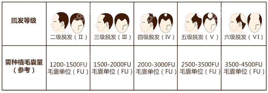 植发数量参考图