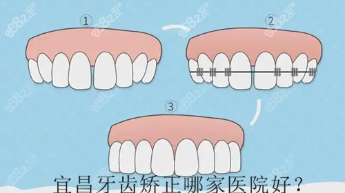 宜昌牙齿正畸哪家医院好？