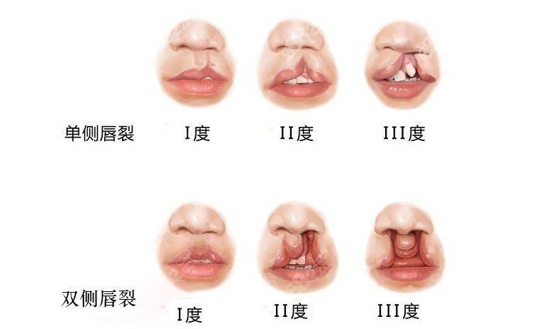 m.8682.ccⅠ度Ⅱ度Ⅲ度唇裂图片
