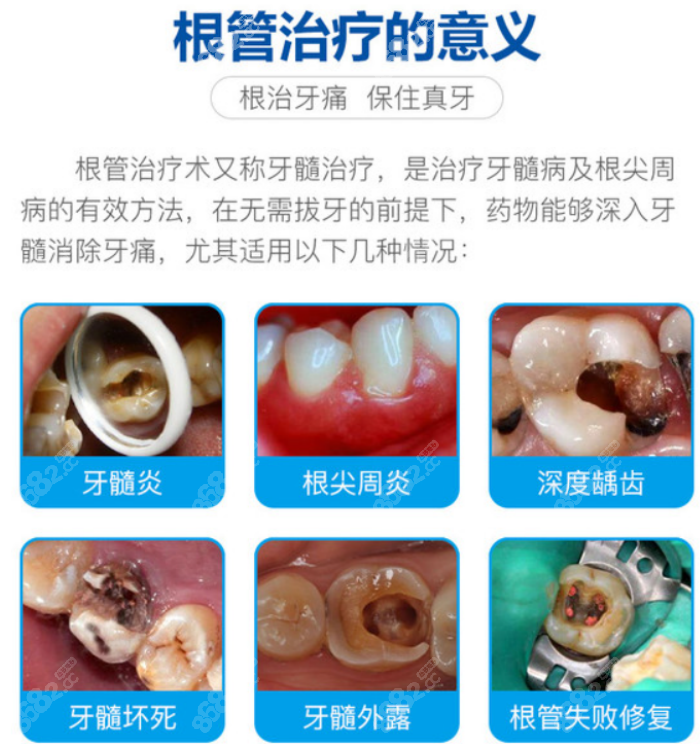 口腔医院根管治疗价格