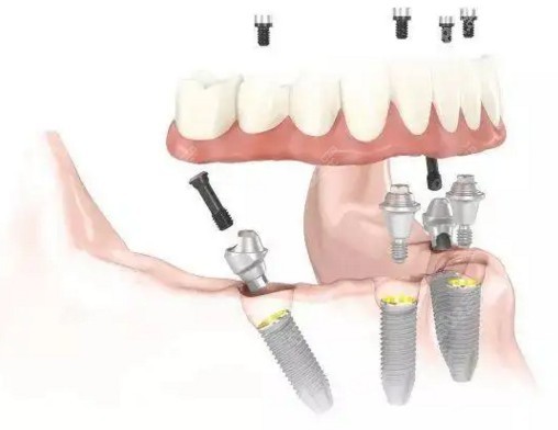 半口allon4种植牙图片