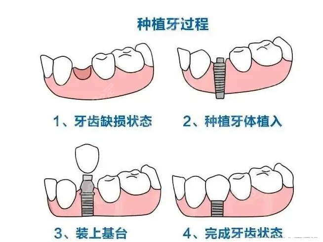 种植牙过程和步骤图解