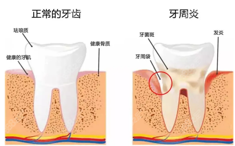 口腔医院牙周炎治疗