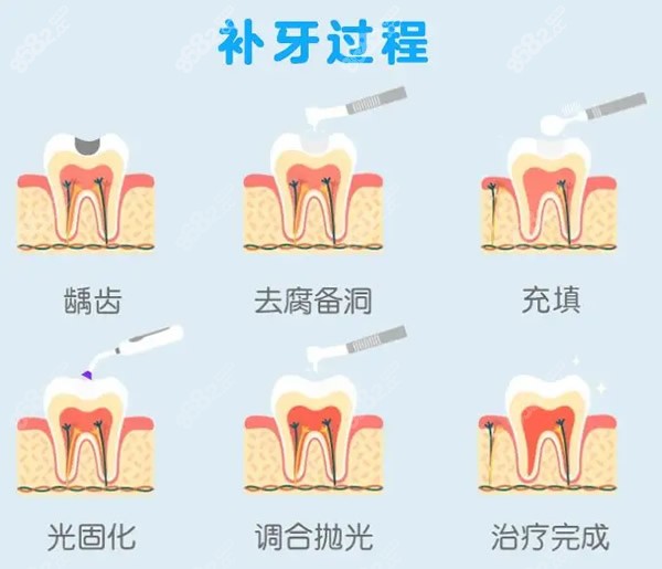 补牙过程和步骤图解