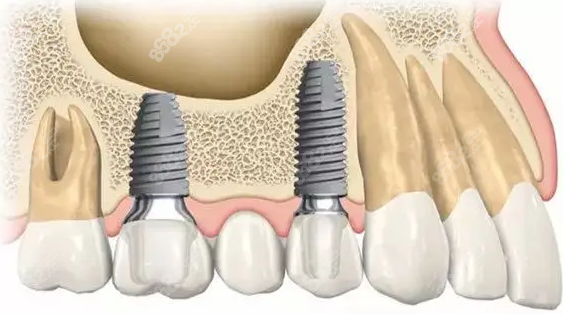 2022大连市口腔医院种植牙价格表