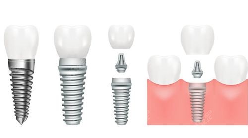 种植牙过程