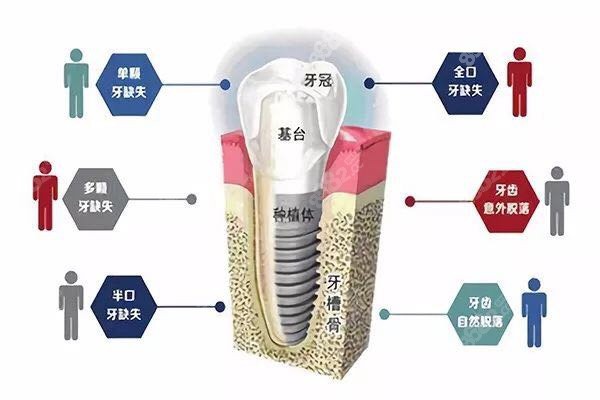 种植牙的组成以及种植牙的适应症