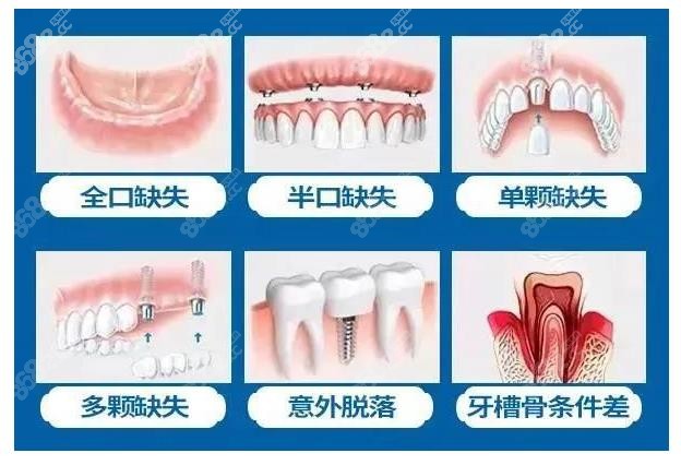 杭州亮贝美口腔医院种植牙多少钱一颗
