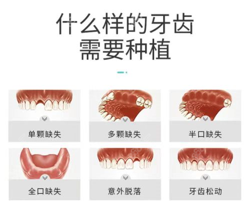 兰州皓亚口腔林捷医生做种植牙类型