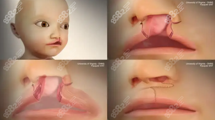 唇腭裂修复手术过程图示