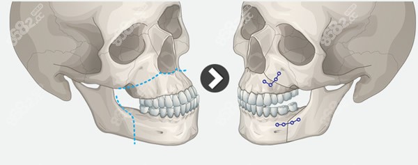 上下颌骨正颌手术过程和原理图解