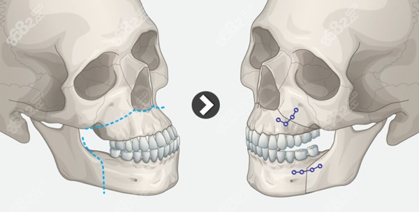 双鄂正颌手术截骨原理图解