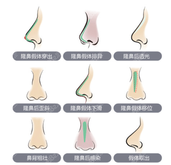 北京鼻修复可以改善的鼻型