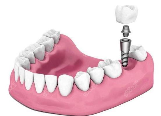 上海伊莱美口腔种植牙示意图