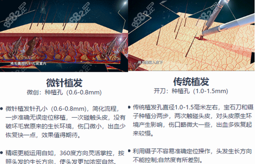 大麦（原科发源）微针植发技术优势
