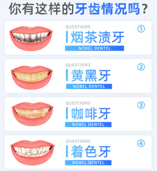 南宁诺贝尔口腔洁牙类型