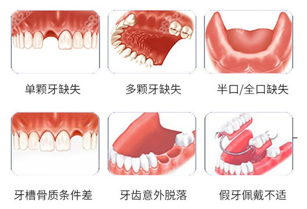 现在种植一口牙需要多少钱