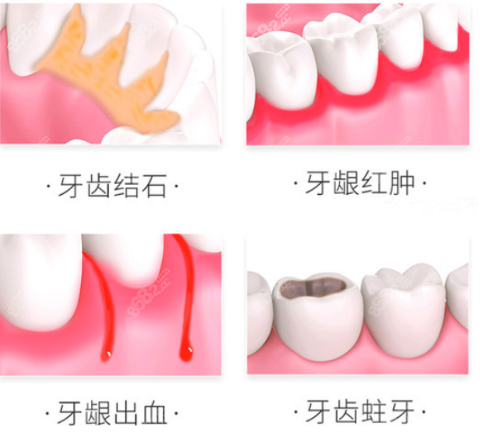 极光口腔医院洁牙