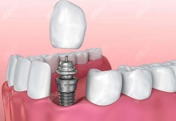 <!--<i data=20240705-sp></i>-->种植牙价格