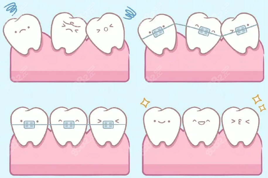 在上海医院的牙科矫正牙需要多少费用