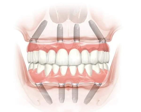 深圳全口种植牙哪家医院好8682.cc