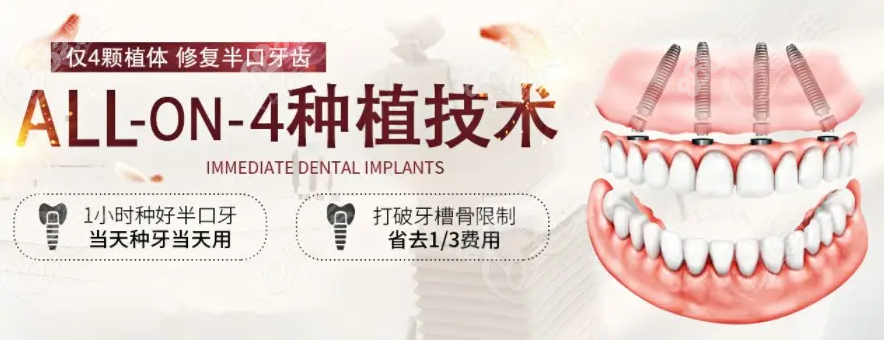 AII-on-4种植技术优势 AII-on-4种植技术优势