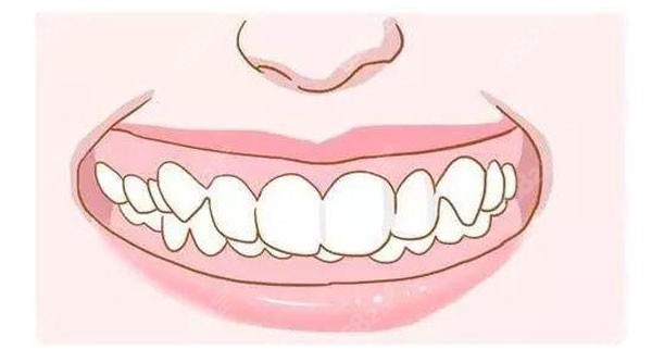 深覆合隐形牙套