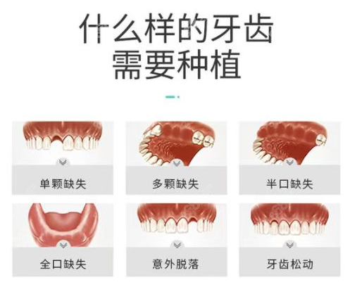 兰州诺贝尔口腔做的种植牙类型