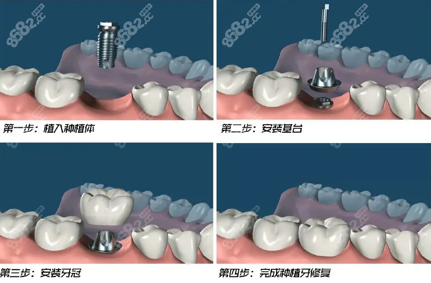 8682.cc山东日照博恩口腔医院种植牙流程