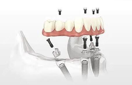 深圳种植牙补贴是真是假8682.cc 深圳种植牙补贴是真是假8682.cc