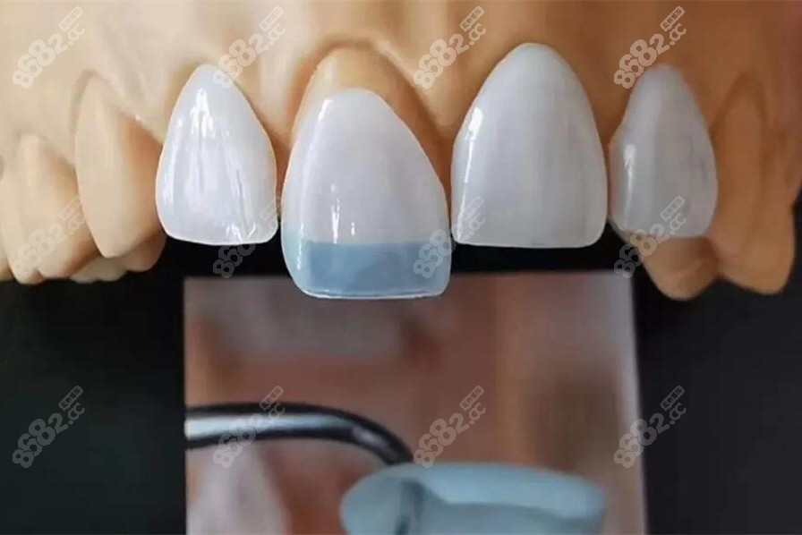 超薄瓷贴面在牙模上的展示图