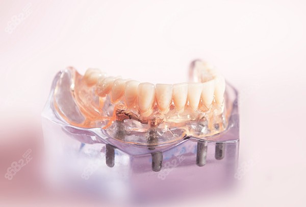 极光口腔种植牙价格